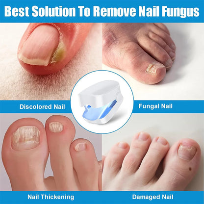 Nail Fungus Laser Treatment Device Repair Toenail Fingernail Fungus Treat Onychomycosis Laser Nails with Mushrooms Relaxation